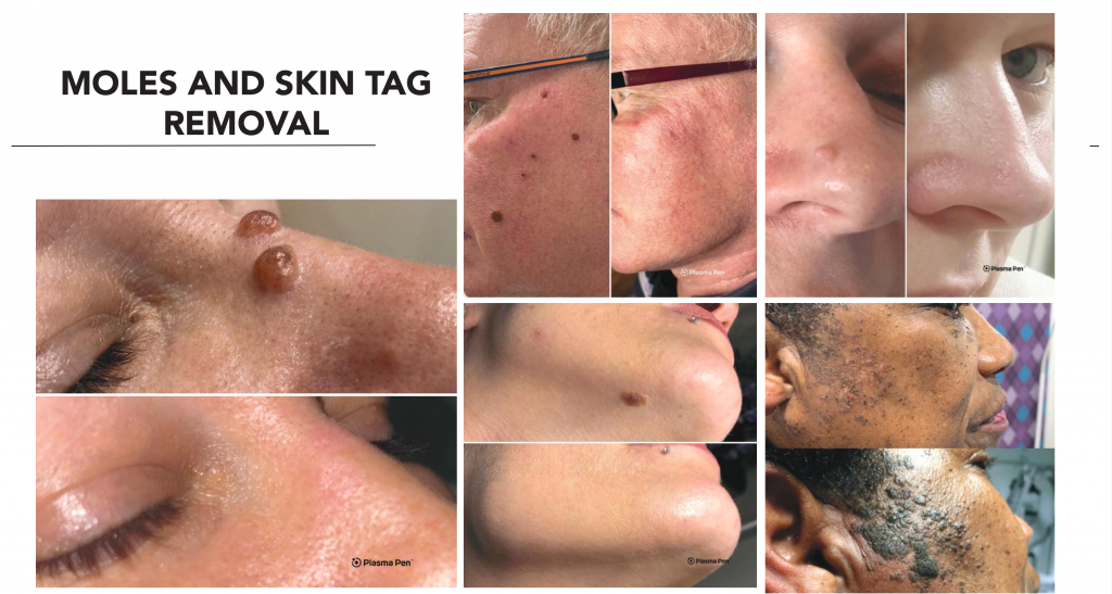 Before and after examples of mole and skin tag removal using Plasma Pen technology